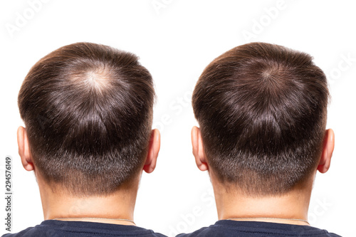 Hair loss. Men view from the back, comparison of hair before and after transplantation. bald head. baldness treatment. Medicine. thick healthy hair. head. people - problem hair, white background.  photo