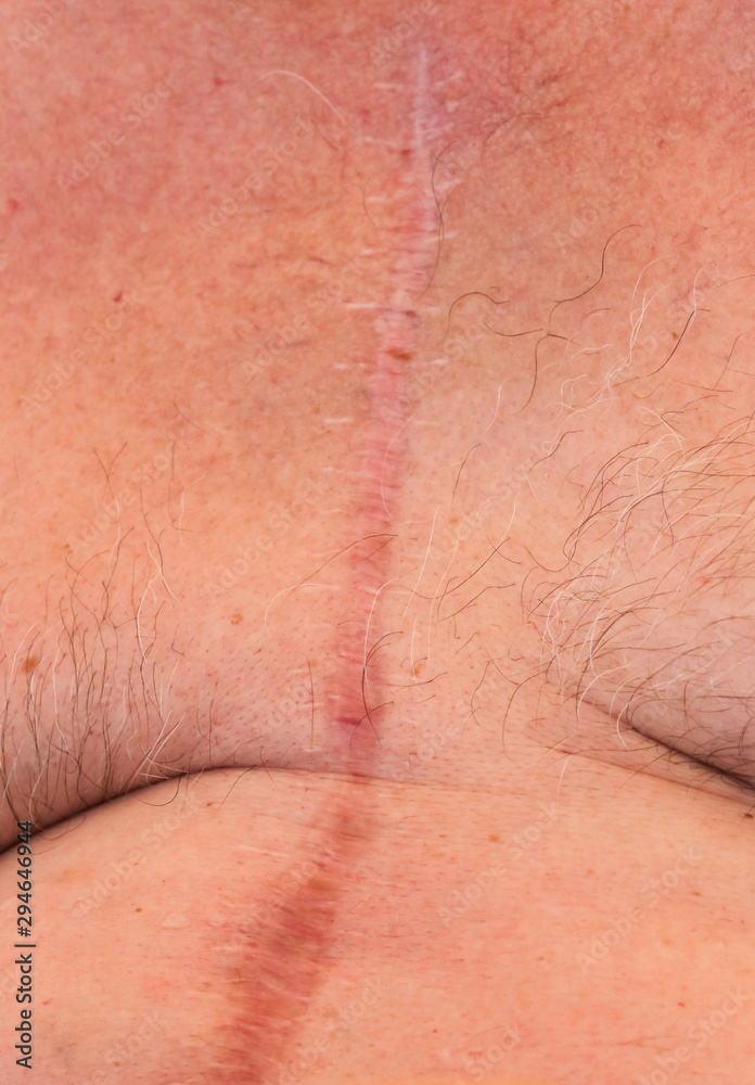 Fototapeta premium A scar from a heart operation
