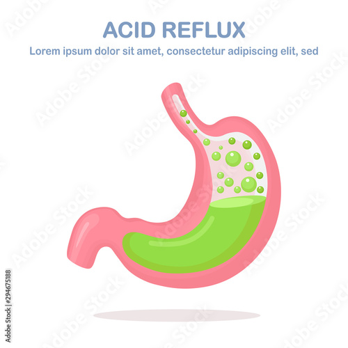 Human stomach. Gastroesophageal reflux disease. GERD, heartburn, gastric infographic. Acid moving up into the esophagus. Vector flat design