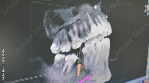 Digital radiography of dental implant photo