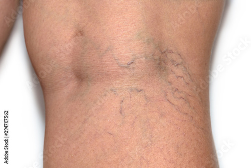 Close up varicose spider vein on skin crook leg elderly woman, Problem thrombosis that can cause blood vessel to clot, Vascular and venous diseases, Health care before the doctor on white background