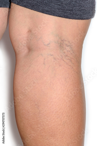 Close up varicose spider vein on skin crook leg elderly woman, Problem thrombosis that can cause blood vessel to clot, Vascular and venous diseases, Health care before the doctor on white background