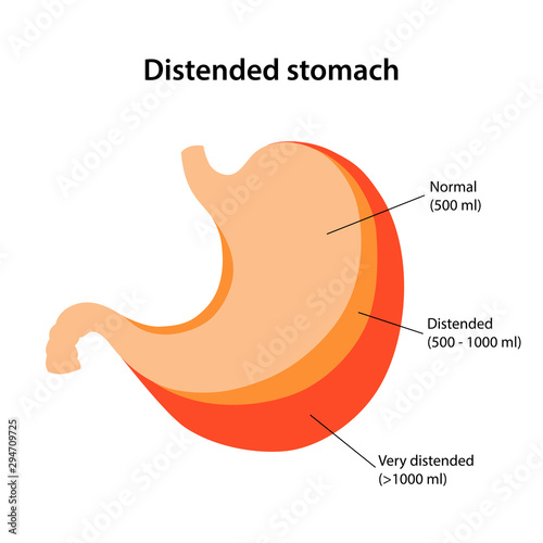 Distended stomach. Stages of distension of the stomach. Flat vector illustration isolated over white background.
