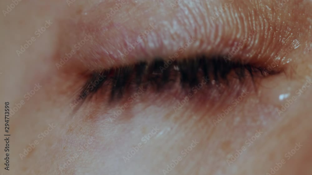 Woman applying drops to treat conjunctivitis Woman applying drops to treat conjunctivitis