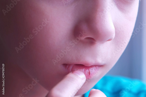 Little cracked cut on boy's lip. Child boy with herpes sore on the lip, mouth closeup. He is touching his lip with finger. Process of dehydration during illness.