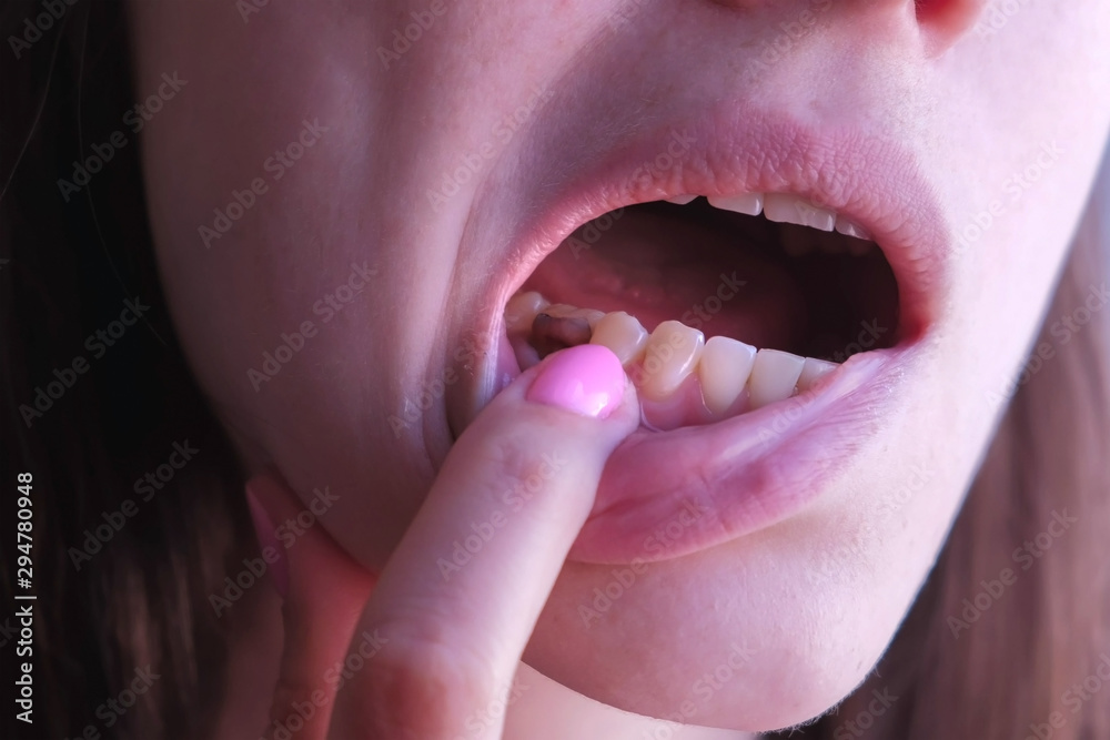 Woman shows her pain tooth. Pink tooth with caries and cured with using