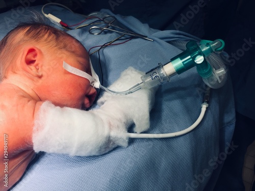 Fotografía Newborn during a surgery