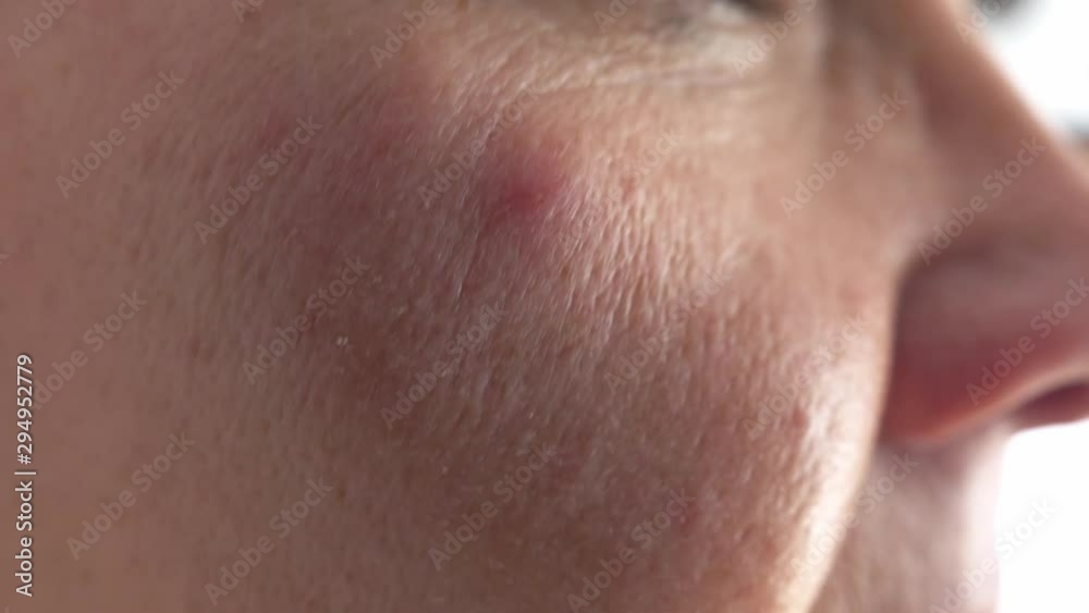 Acne on the cheek of an old woman close-up Acne on the cheek of an old woman close-up
