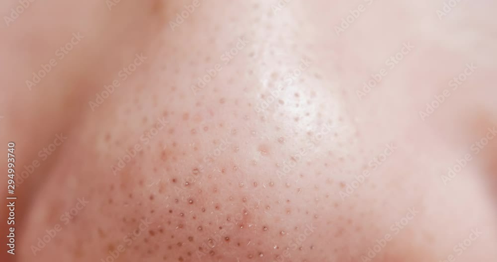 blackheads on woman nose blackheads on woman nose
