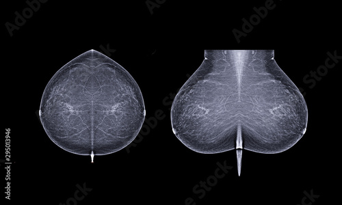 Quadro su tela Basic position X-ray Digital Mammogram both side name is CC view and MLO