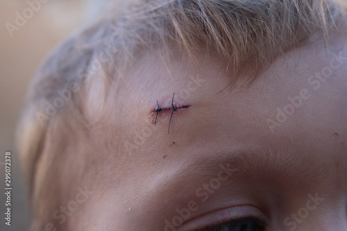 cicatrice bébé point de suture