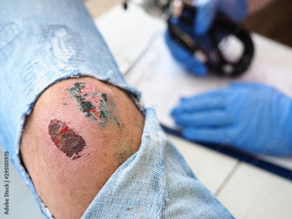 The doctor examines the healing wound of the patient on the leg of the knee torn jeans scarring