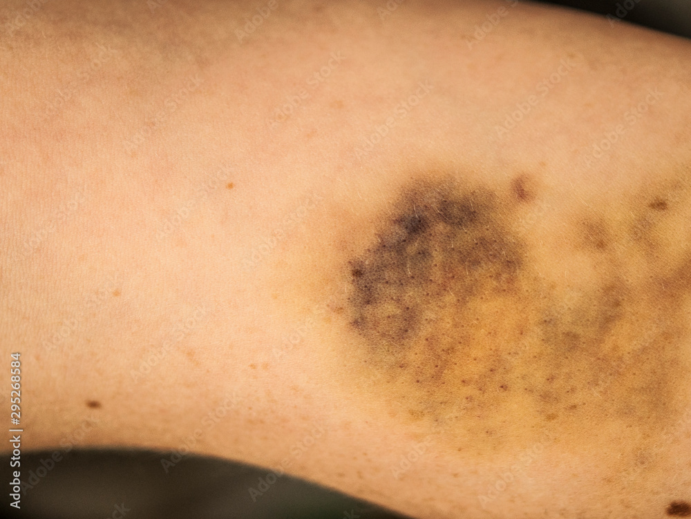Fototapeta premium large hematoma on human arm