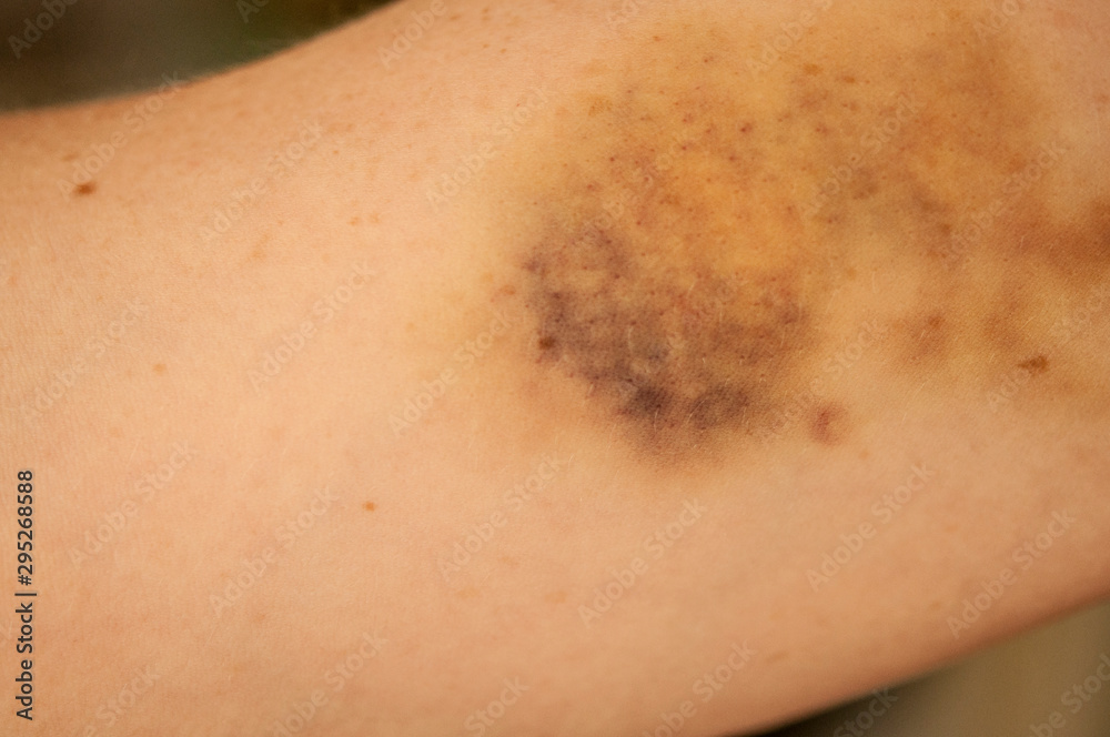 Fototapeta premium large hematoma on human arm