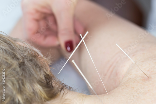 Elderly woman undergoing acupuncture procedure in a spa.