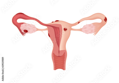 Endometriosis. Sick female reproductive system isolated on white background. Realistic drawing showing the internal organs. Frontal view in a cut.