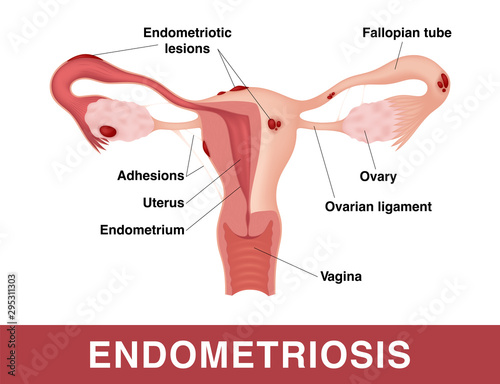 Endometriosis. Vector medical illustration with inscriptions. Realistic drawing showing sick female reproductive system.