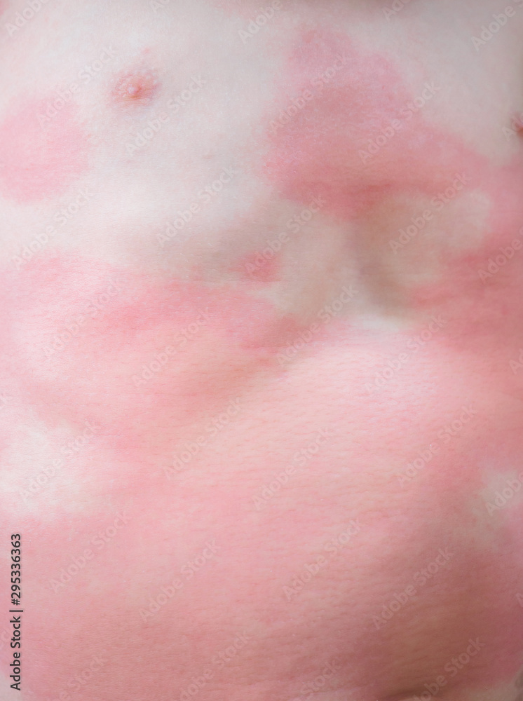 Severe eczema skin rash and allergic reaction symtom at little asian child body cause by hypersensitivity Severe eczema skin rash and allergic reaction symtom at little asian child body cause by hypersensitivity