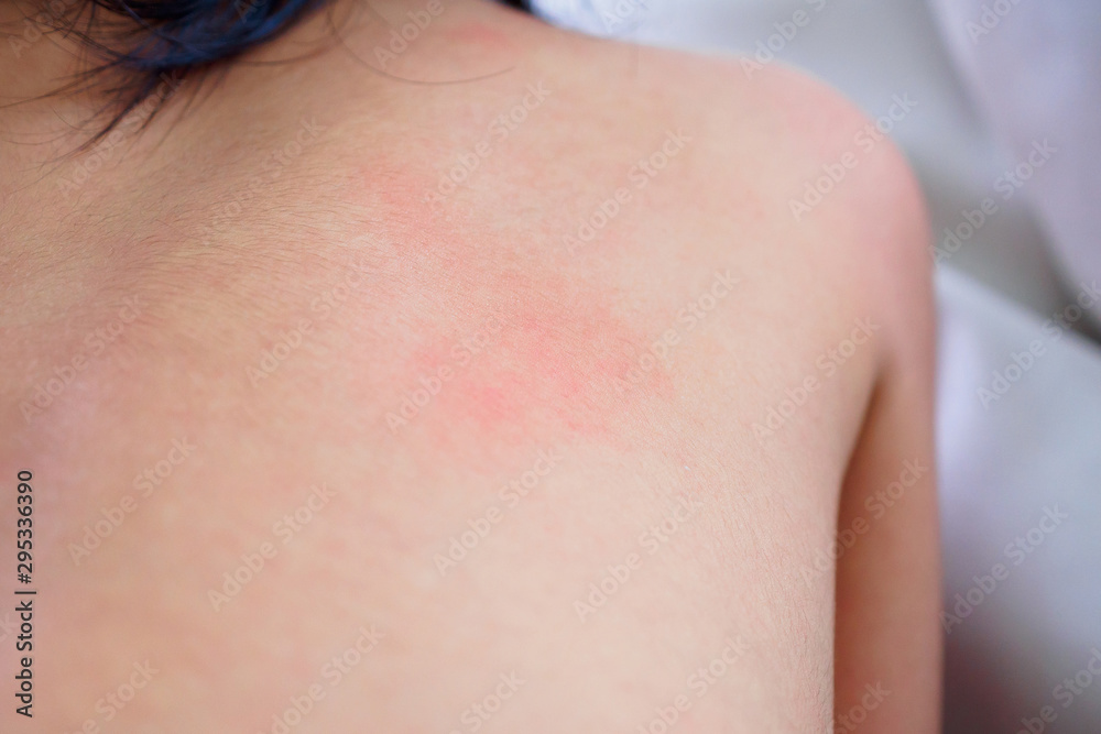 Fototapeta premium little asian girl skin rash and allergy with red spot cause by mosquito bite at back