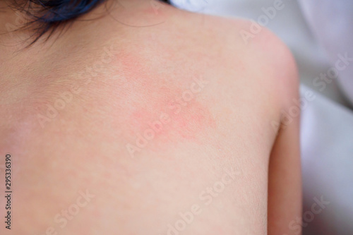 little asian girl skin rash and allergy with red spot cause by mosquito bite at back