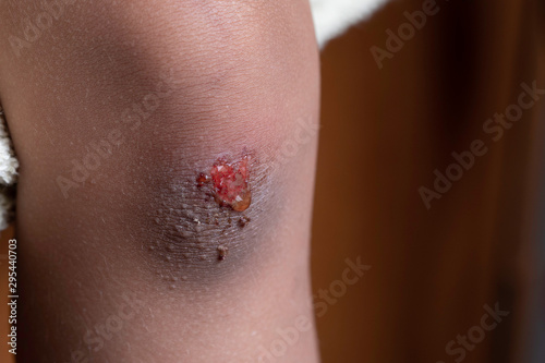 Scratched knee and bruise close up with red blood and serosanguinous fluid drops