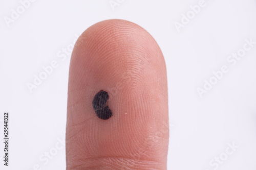 Фотография Pigmentation on fingertip skin close up
