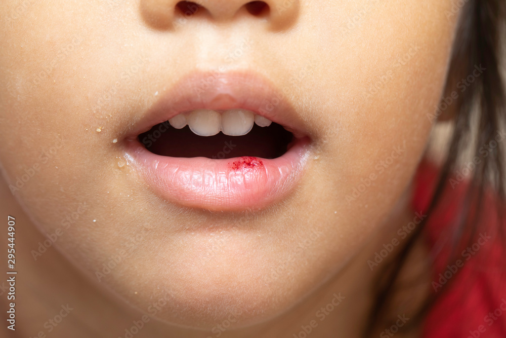 Obraz premium Injury, wound on child lip close up