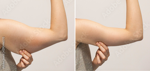 Vászonkép Flabby arm skin and slim hand comparison