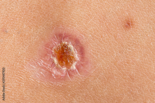 Принти на полотні Wound healing up, inflammation on skin close up