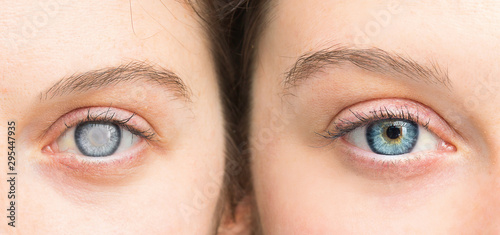 Person with white pupil and healthy eye comparison close up