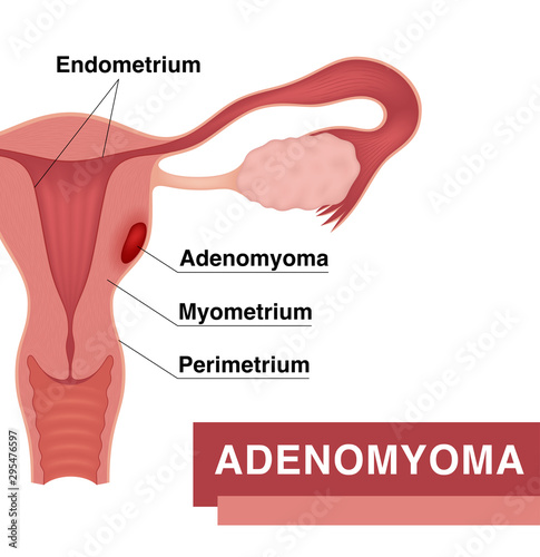 Local adenomyoma. Vector medical illustration with inscriptions. Realistic drawing showing cross section of sick female reproductive system.