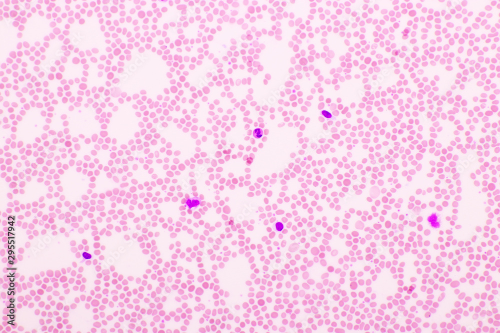 Picture of white blood cell, red blood cell and platelet in blood film