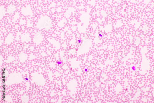 Picture of white blood cell, red blood cell and platelet in blood film