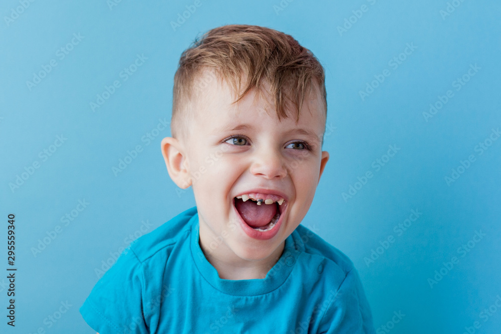 Extensive early dental caries and misaligned and spare incisor teeth in upper jaw Extensive early dental caries and misaligned and spare incisor teeth in upper jaw
