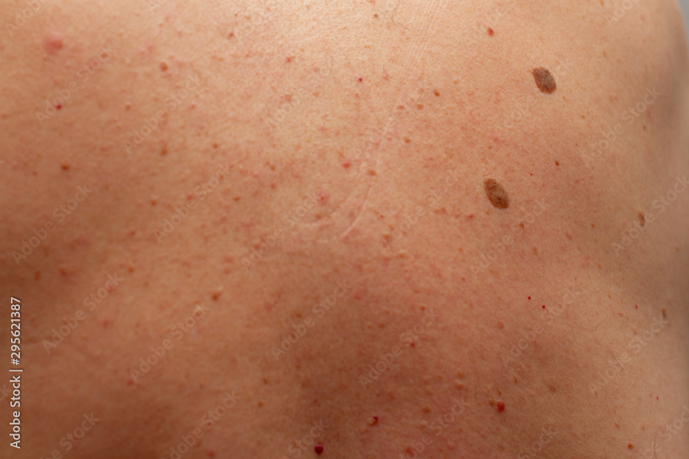 many different moles on the back of a man
