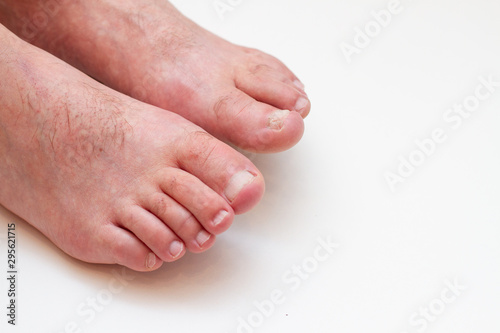 male feet with toenail fungus on a white background isolated © epovdima