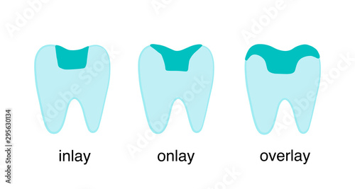 Inlay onlay overlay tooth crown restoration porcelain hand drawn vector illustration type classification