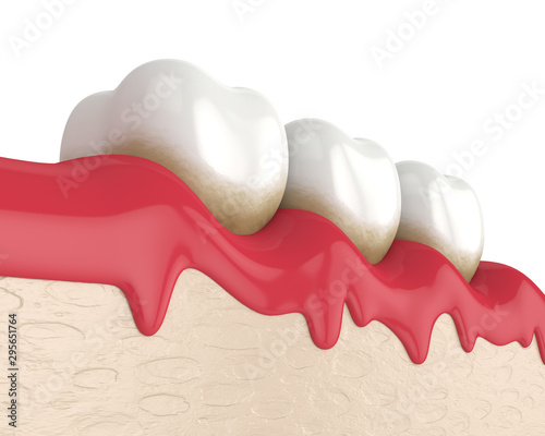 3d render of teeth in bleeding gums photo