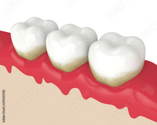 Obraz na plátně 3d render of teeth in bleeding gums