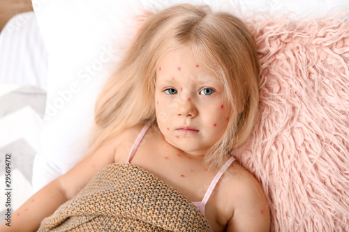 Little girl ill with chickenpox lying in bed