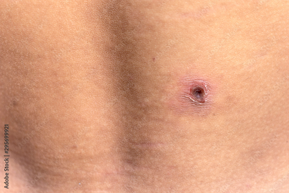 Wound infection on the skin. Skin ulcers of diabetic patients. Wound infection on the skin. Skin ulcers of diabetic patients.