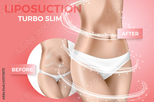 vector illustration about liposuction, before and after. Fat removal program, realistic female body slim and obese.