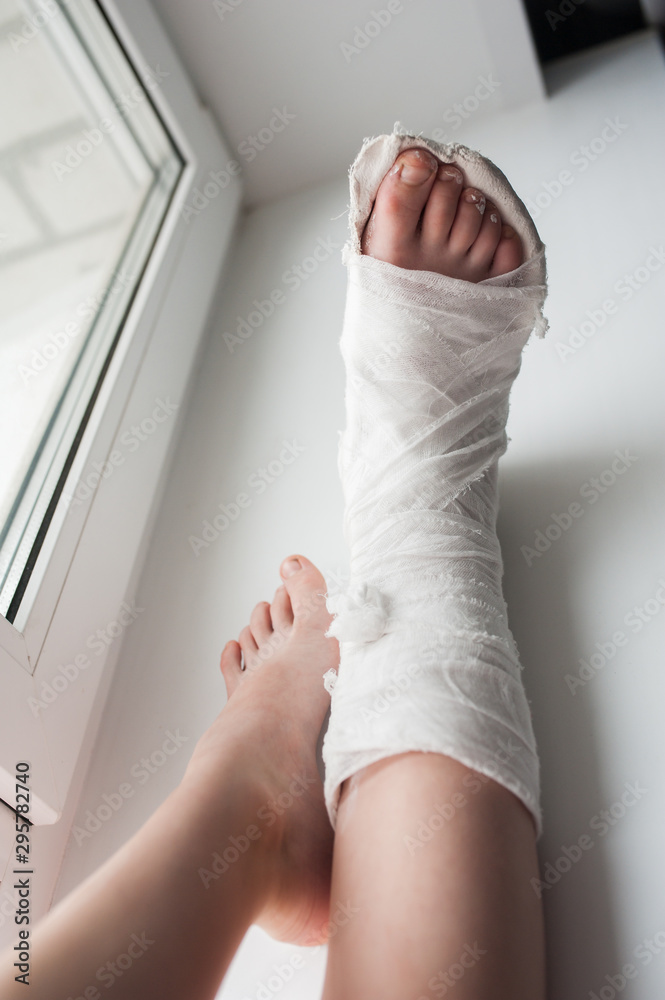 Foto de Broken leg in a medical plaster on a windowsill do Stock | Adobe  Stock