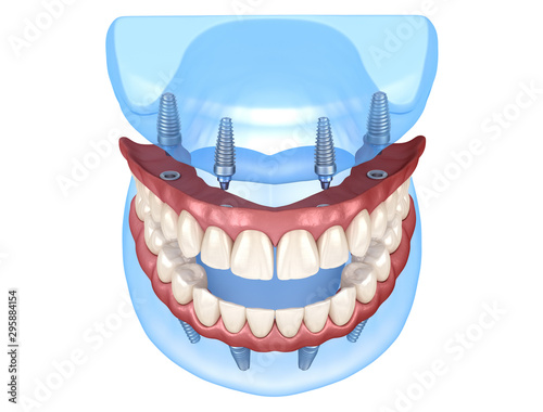 Maxillary and Mandibular prosthesis with gum All on 4 system supported by implants. Medically accurate 3D illustration of human teeth and dentures