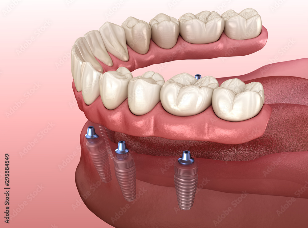Mandibular prosthesis with gum All on 6 system supported by implants. Medically accurate 3D illustration of human teeth and dentures concept Mandibular prosthesis with gum All on 6 system supported by implants. Medically accurate 3D illustration of human teeth and dentures concept