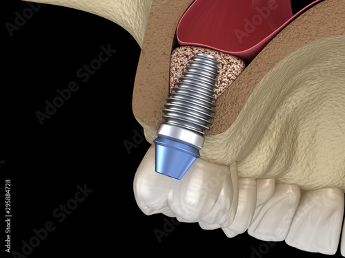 Sinus Lift Surgery - implant installation. 3D illustration photo