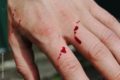 Man's hand has been freshly scratched by a cat in the garden. Fresh blood is coming out out of the skin layer. Splash of blood drops on a white flower