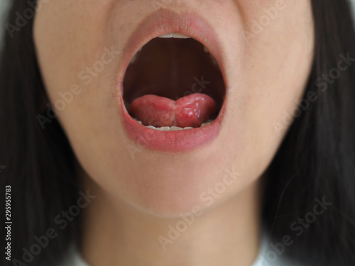 Canvas Print ankyloglossia in asian woman and cause of an unusually short of tissue tethers t