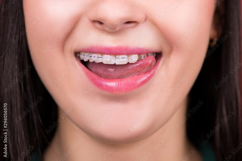 Smiling happy woman mouth with tongue and braces Smiling happy woman mouth with tongue and braces