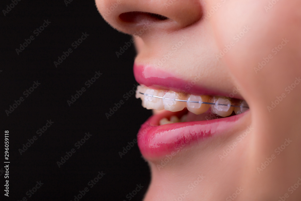 Obraz premium Braces. Beautiful Woman healthy smile close up. Closeup Ceramic Braces on Teeth. Beautiful Female Smile with Braces. Orthodontic Treatment.